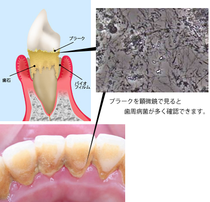 ひかりのテラス歯科クリニックプラス_歯周病治療